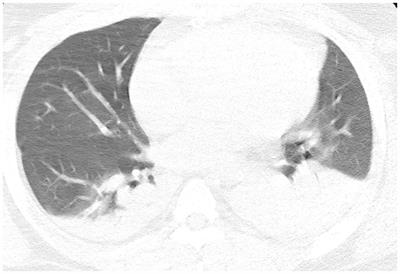 Case report: Prone positioning in the improvement of severe post-operative hypoxia following aortic dissection